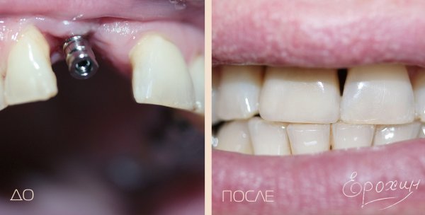 Коронка из диоксида циркония a la naturel на импланте | Краснодар