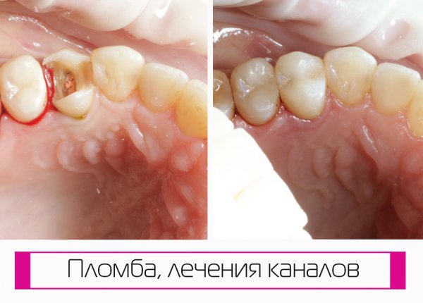 Пломбирование каналов зуба в стоматологии на Тургенева - Краснодар