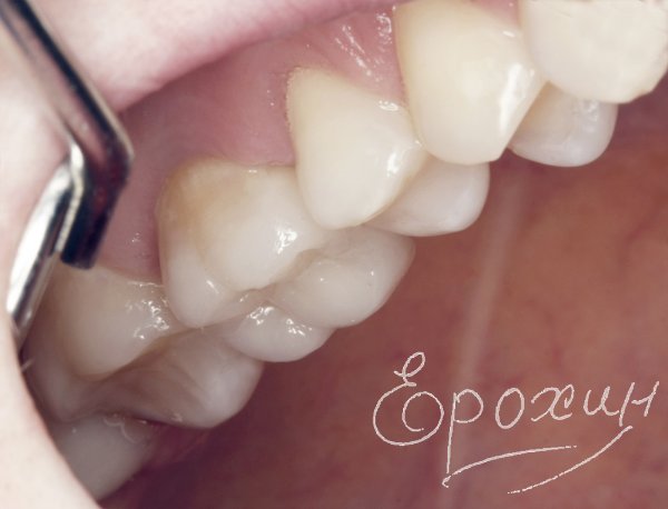 Накладка из керамики e-max в Краснодаре