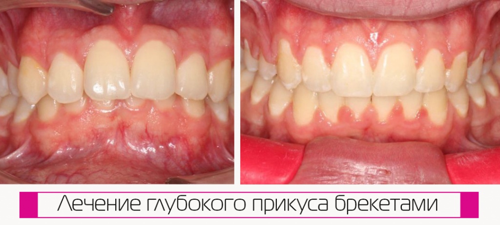 исправление брекетами глубокого прикуса