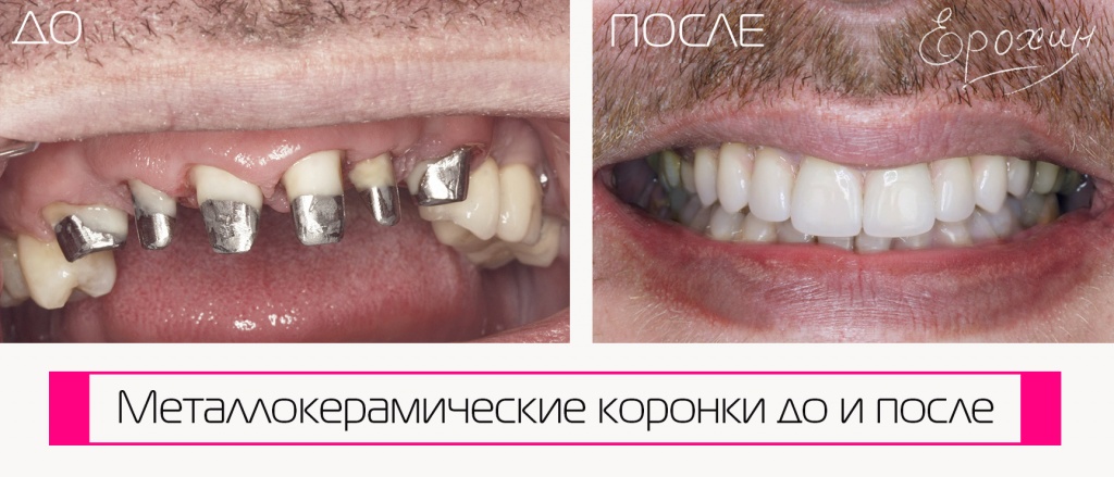 Dr. A.V. Erokhin performed the dental restoration, placing high-quality metal-ceramic crowns. See the remarkable transformation in the before-and-after photos. Krasnodar, FMR Dr. A.V. Erokhin performed the dental restoration, placing high-quality metal-ceramic crowns. See the remarkable transformation in the before-and-after photos. Krasnodar, FMR