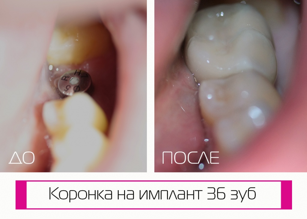 Коронки на имплантах в Краснодаре на ФМР: смотрите фото работ до и после лечения Коронки на имплантах в Краснодаре на ФМР: смотрите фото работ до и после лечения