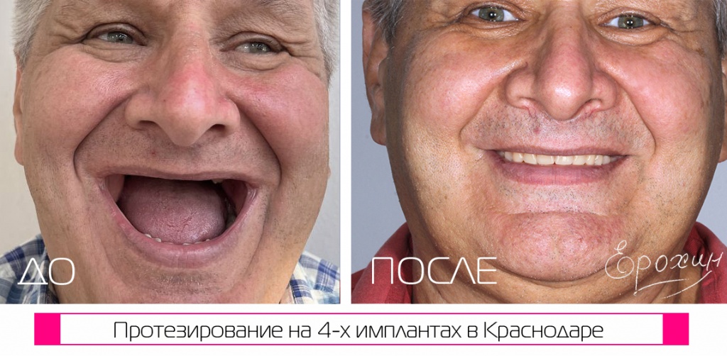 Результат All-on-4 до и после - клиника Dent-Real