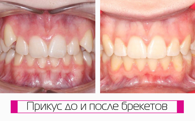 17-летний пациент. Устранили сильное выступание верхних зубов. За 22 месяца лечения брекетами добились гармоничного прикуса и красивой улыбки.