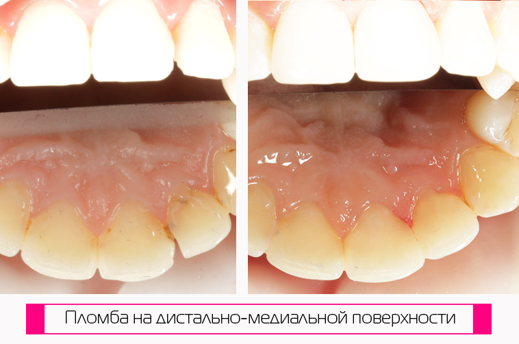 Подбор оттенка пломбы, если кариес между зубов. Фото до и после