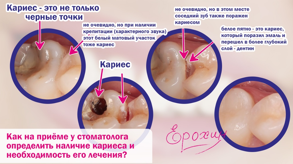 Кариес - это не только черная точка, но и белое пятно