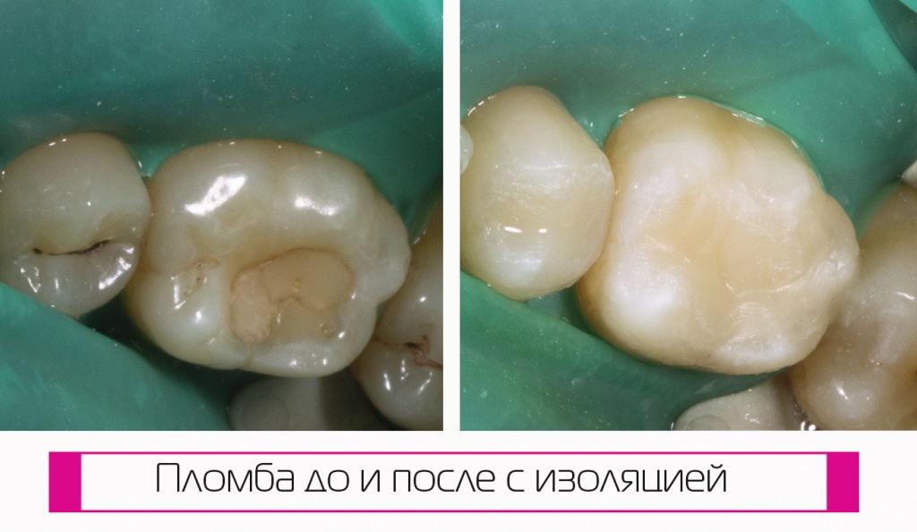 Пломбы поставлены с использованием коффердама. Фото до и после