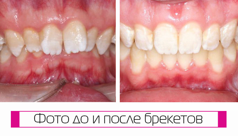 Запись онлайн на лечение брекетами в ФМР. Просмотр портфолио Запись онлайн на лечение брекетами в ФМР. Просмотр портфолио