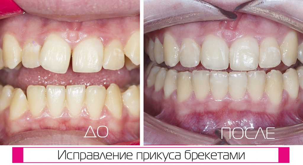 Исправить прикус в Краснодаре брекетами
