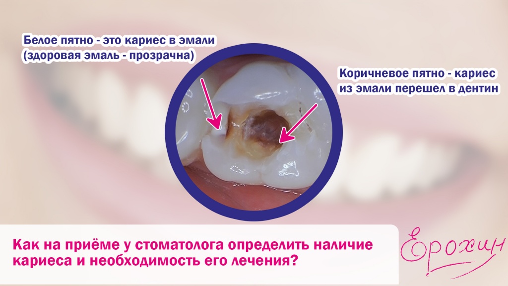 Глубина кариеса зависит только от того как быстро его диагностируют