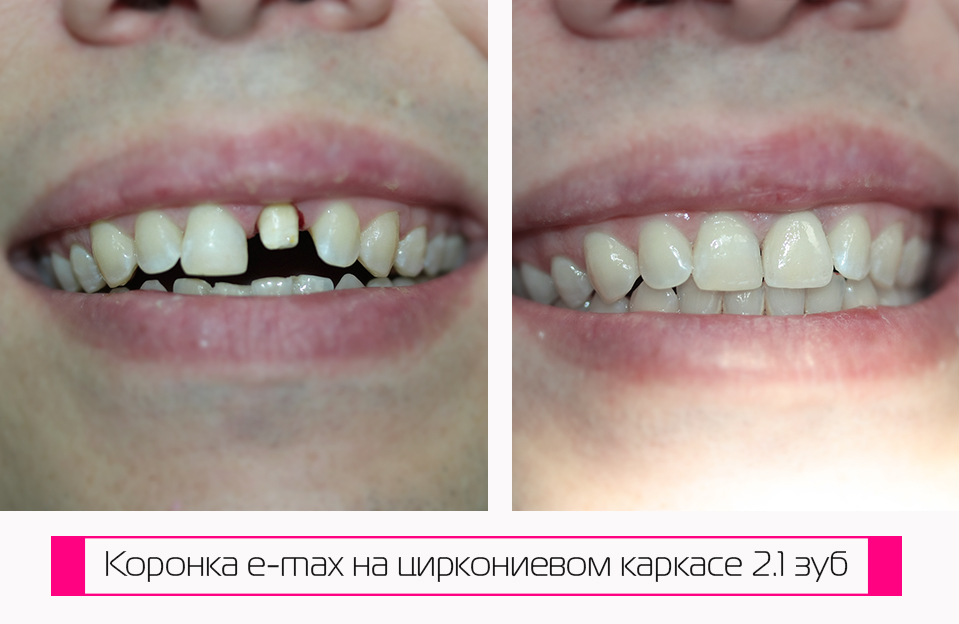 Crown before and after. E-max on a zirconium dioxide frame tooth 2.1 . Made by dentist Erokhin from Krasnodar, FMR, Turgeneva, 145