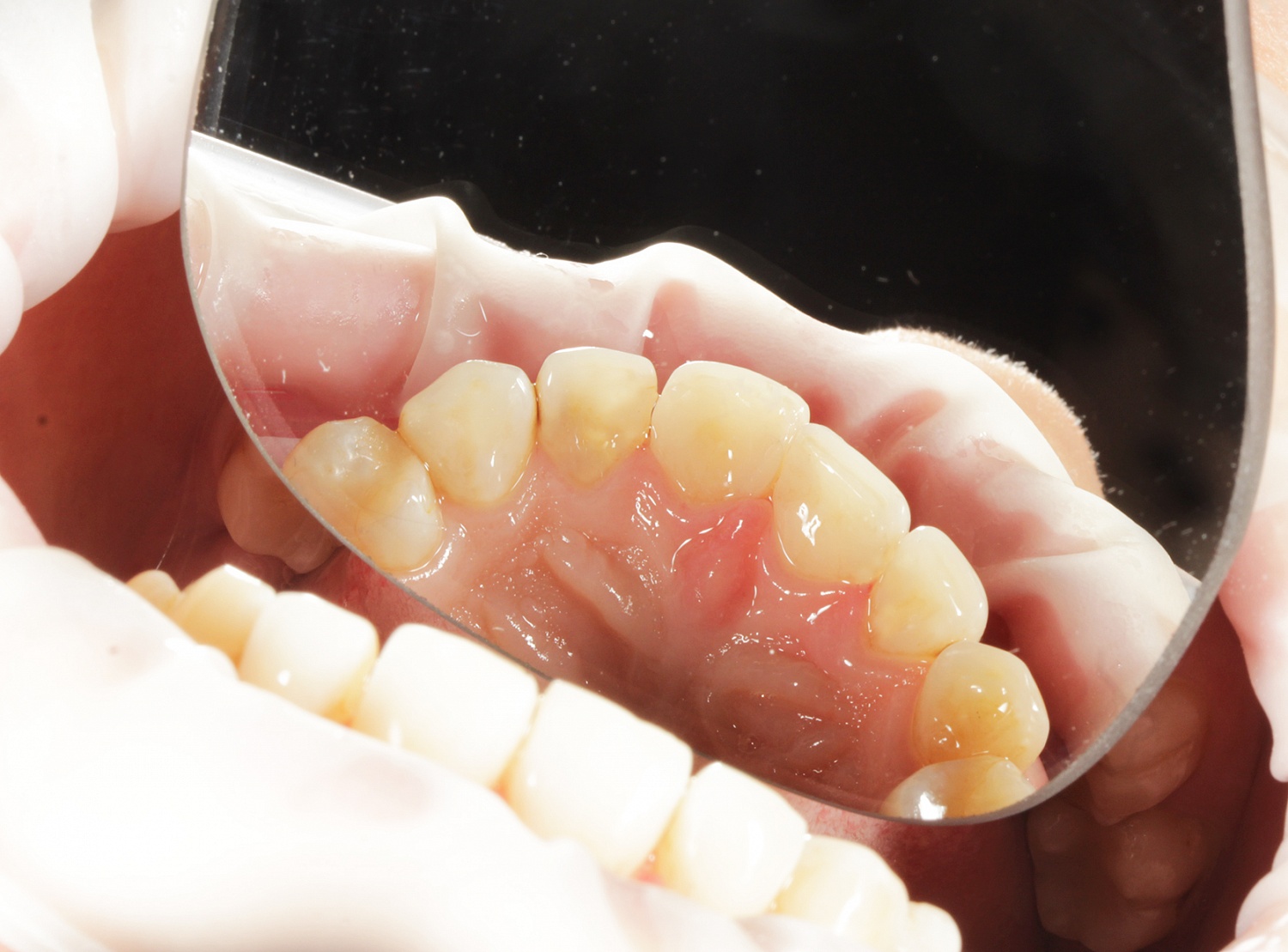 Пломбирование передних зубов 